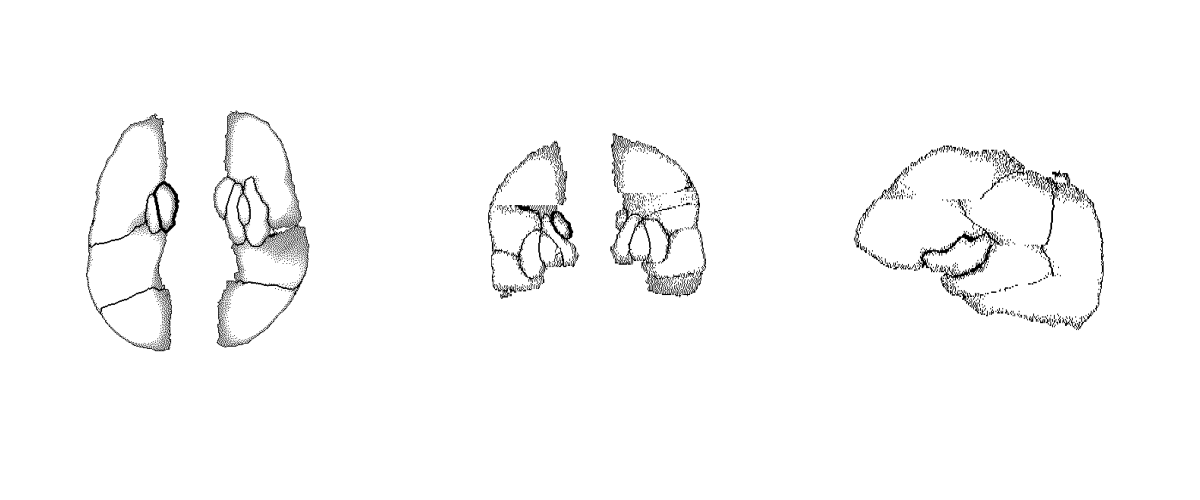 Plot of sagittal, coronal and axial slices of the ASPECTS overlay