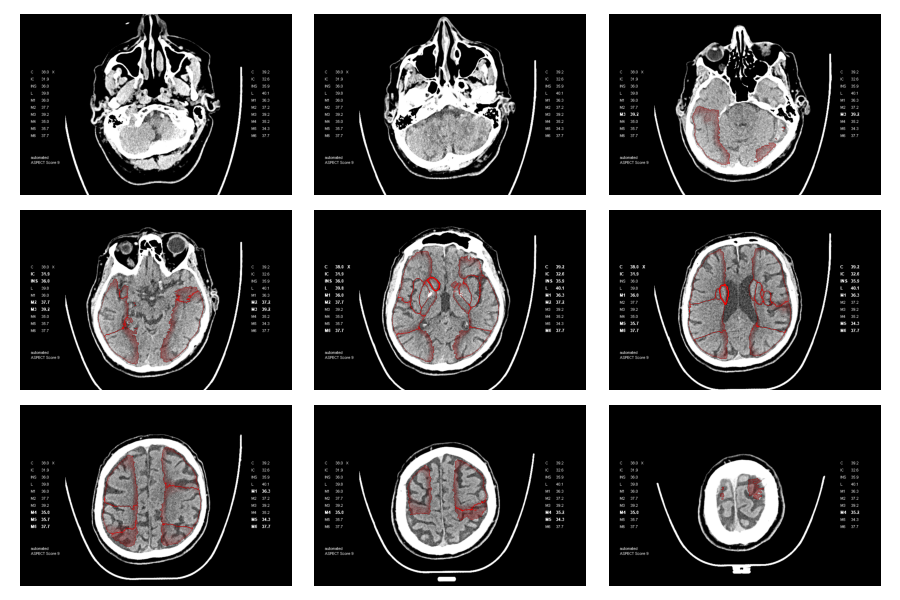 Axial brain CT slices with ASPECTS contour point cloud overlay
